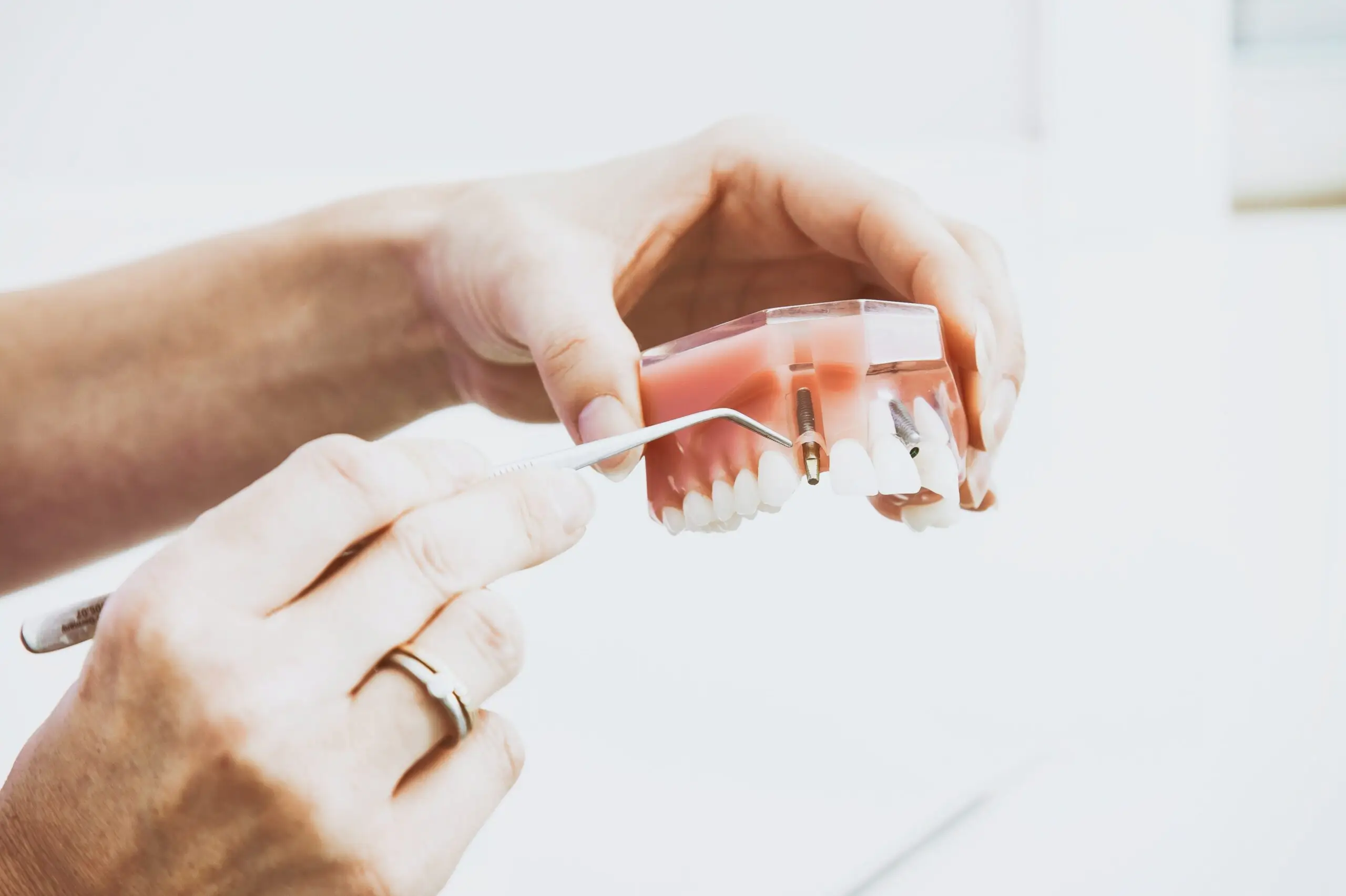 Implante dentário em Osasco - Clínica Amanda Soto